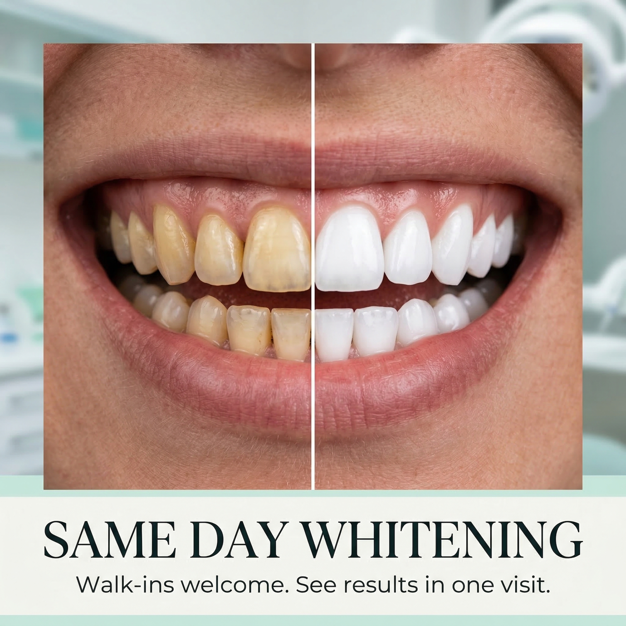 Same Day Whitening — before and after teeth