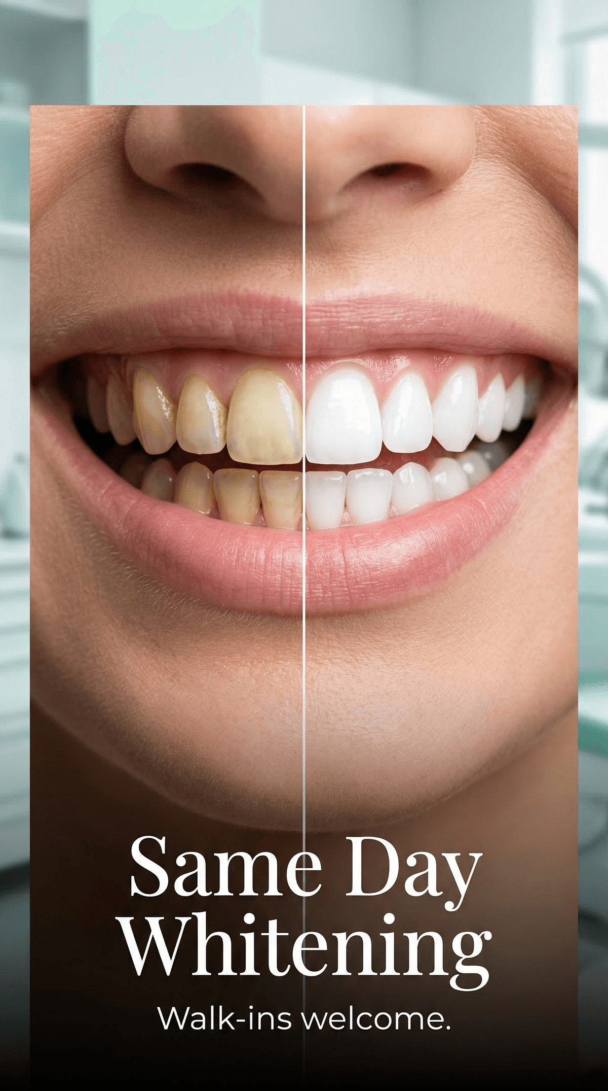 Same Day Whitening — before and after 9:16 Stories format